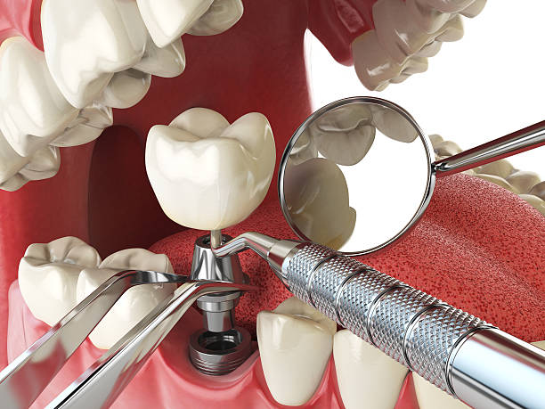 Best Emergency Tooth Extraction in Roanoke Rapids, NC